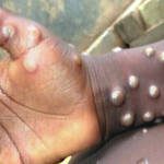 Monkeypox, Newscenta, Ghana, 4 deaths, 116 cases,