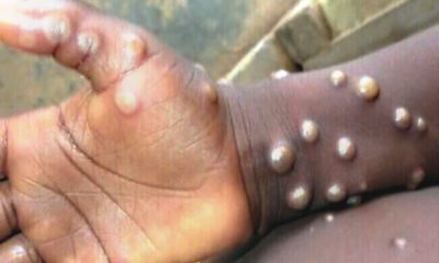 Monkeypox, Newscenta, Ghana, 4 deaths, 116 cases,