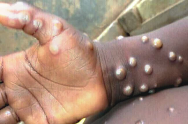 Monkeypox, Newscenta, Ghana, 4 deaths, 116 cases,