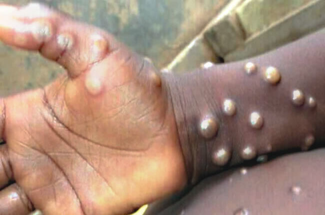 Monkeypox: Ghana records 4 deaths and 116 cases