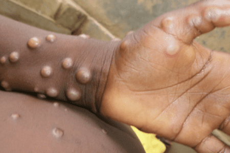 Ghana records first case of MPOX in Western North Region