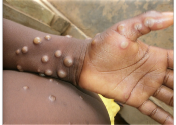 Mpox cases Ghana