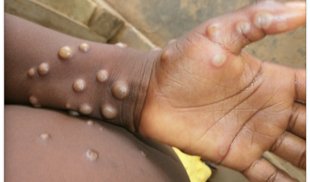 Mpox cases Ghana