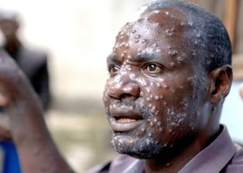 Mpox infections Ghana