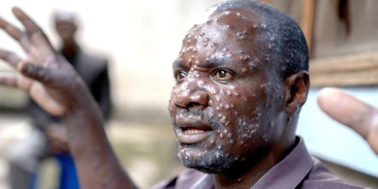 Mpox infections Ghana