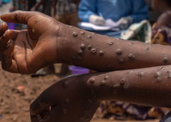 Mpox cases Ghana Health vaccine total