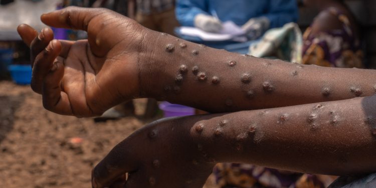 Mpox cases Ghana Health vaccine total
